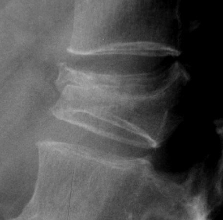 Lumbar spine X-ray