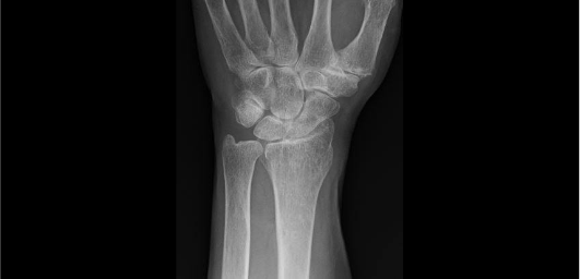 X-ray of the distal radial fracture