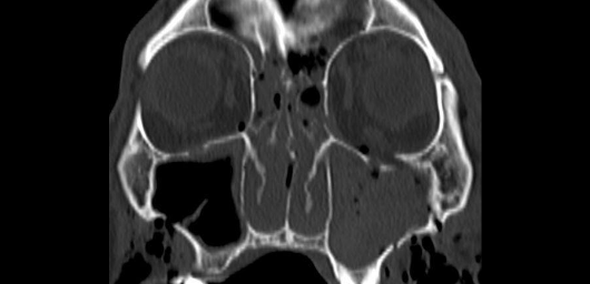 橈骨遠位端骨折のレントゲン画像