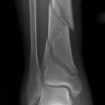 tibial fracture