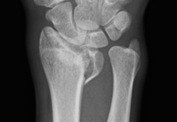 radial fracture