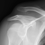 Acromioclavicular joint dislocation