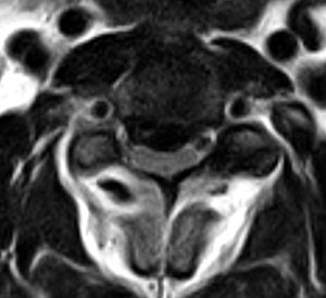 CS-MRI axial image