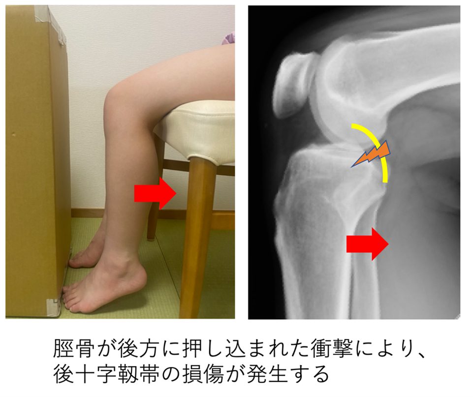 cause of posterior cruciate ligament injury