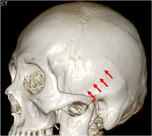 temporal bone fracture 3D