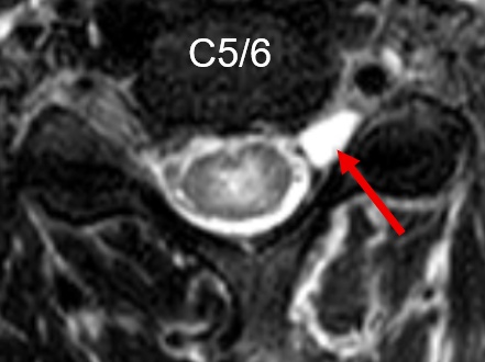 MRI of BPI-axial