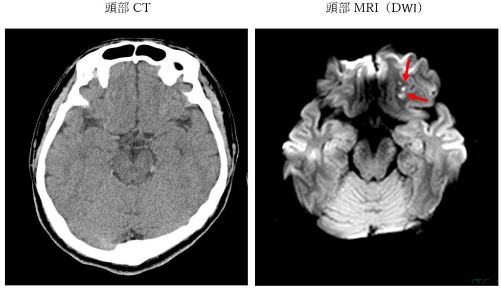 CT vs MRI(DWI)