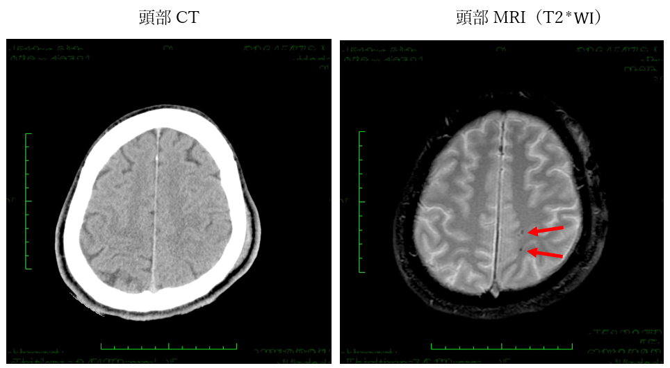 CT vs MRI(T2＊)