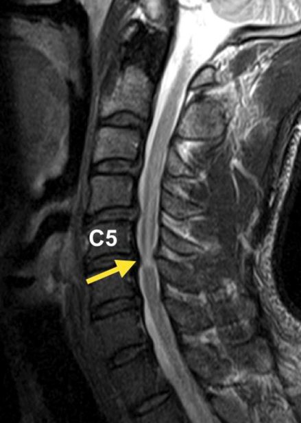 spinal cord injury C5-6
