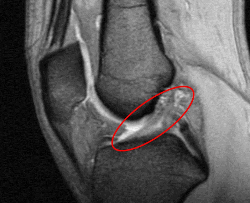 ACL injury MRI