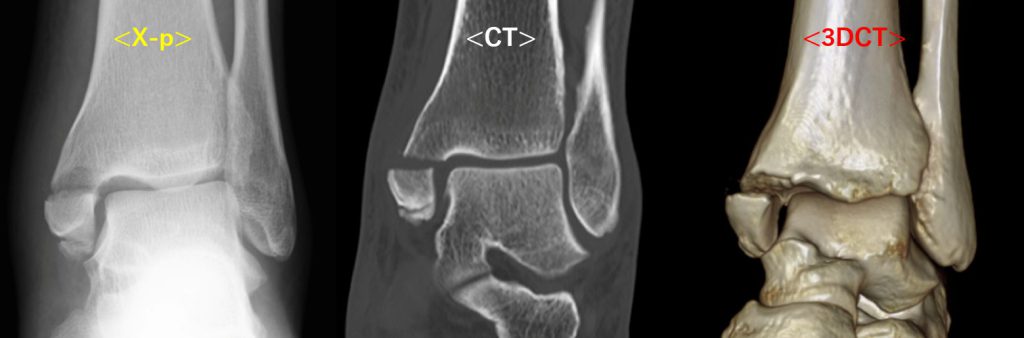 ankle joint2