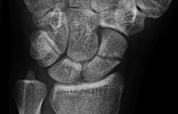 scaphoid fracture