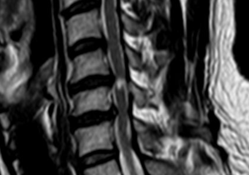 central spinal injury