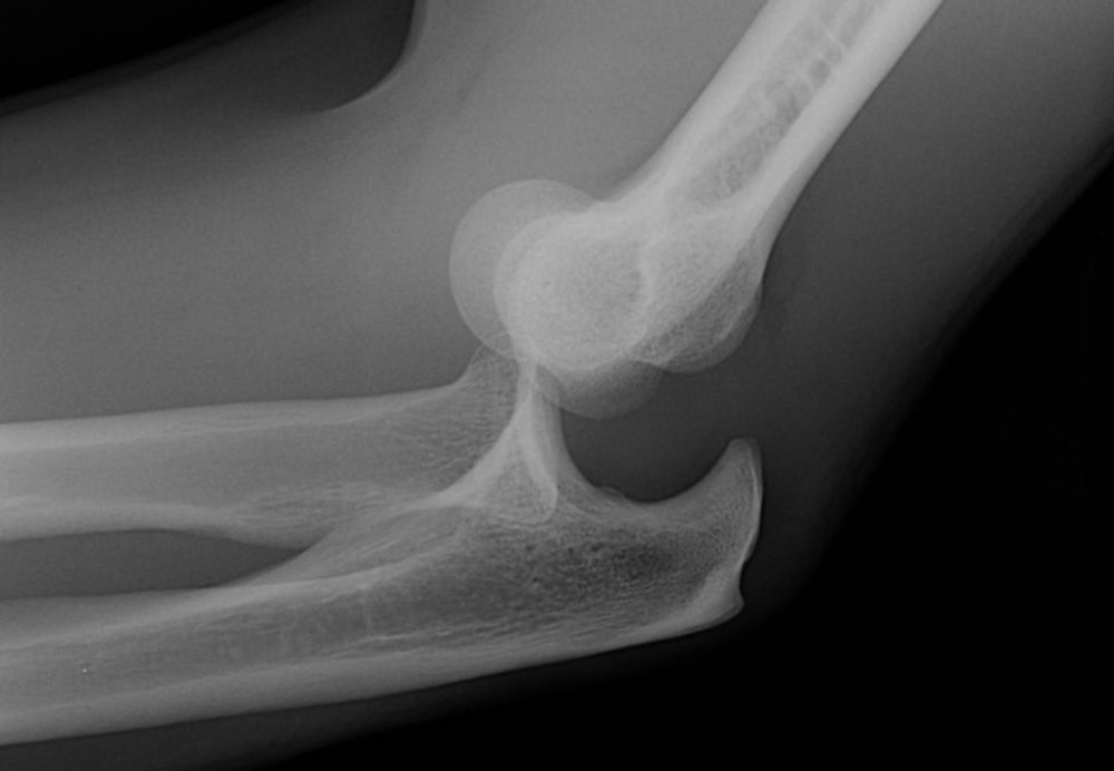 elbow dislocation