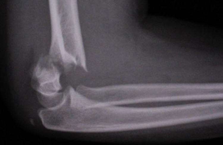 elbow fracture