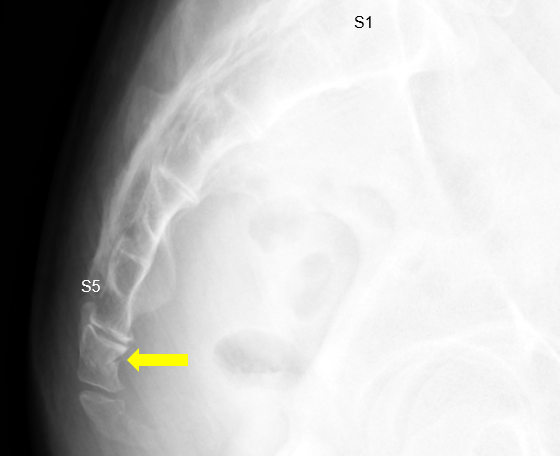 tail bone fracture