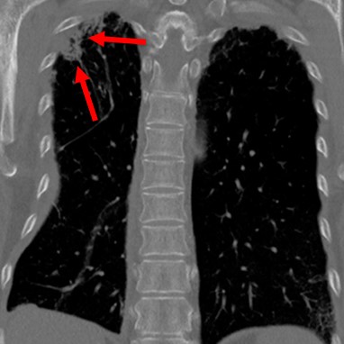 pulmonary contusion