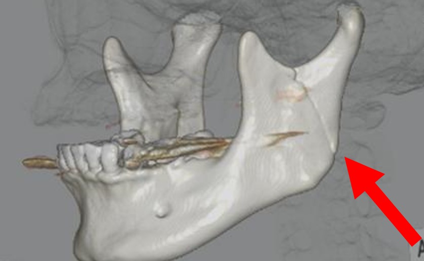 mandible fracture
