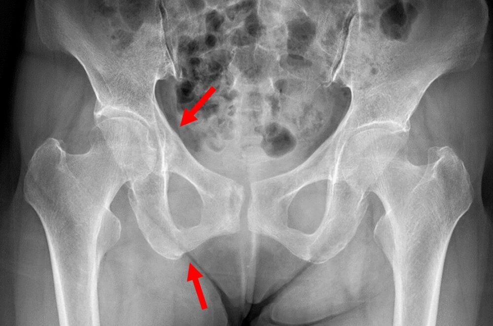 pubic-bone-fracture