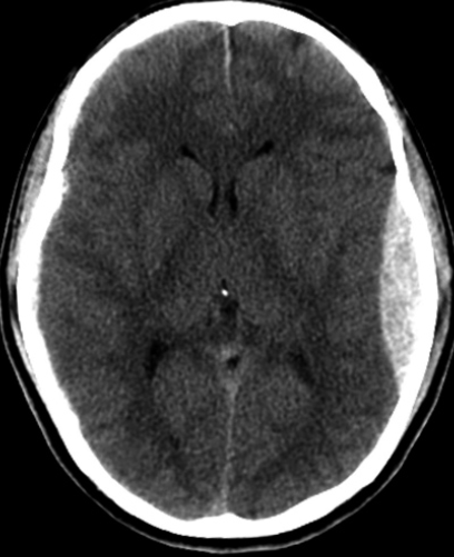 acute epidural hematoma