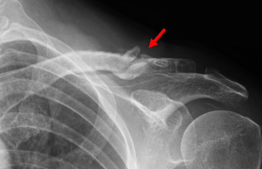 Deformity healing of clavicle fractures