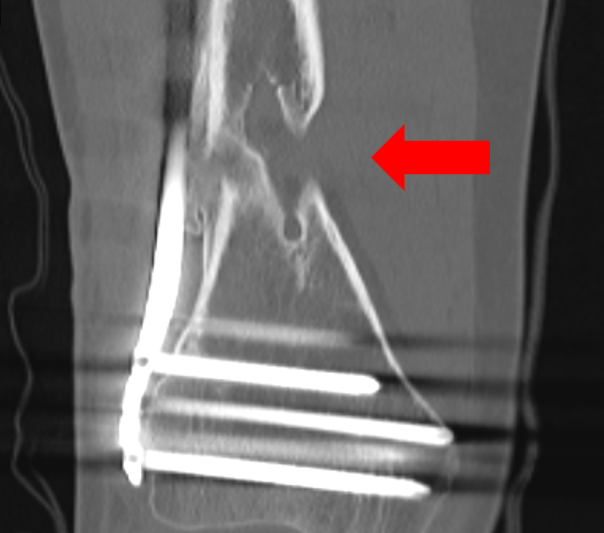 femoral fracture