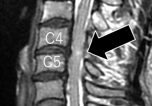 MRI